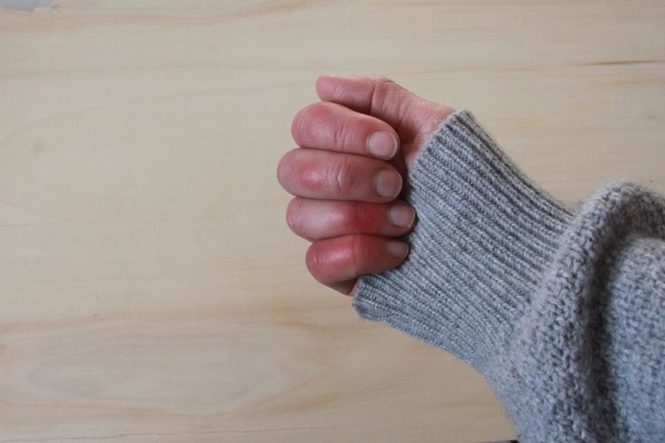 Frostbite, Sumber: kompas.com