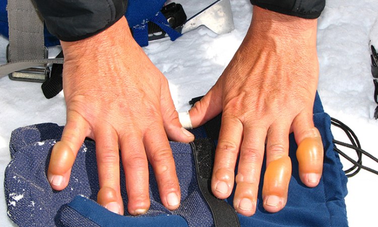 Penanganan pada frostbite, Sumber: halodoc.com